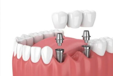 Dental Implants